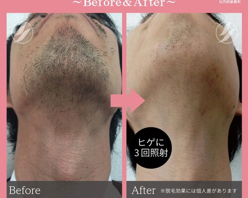 men's　ヒゲ
